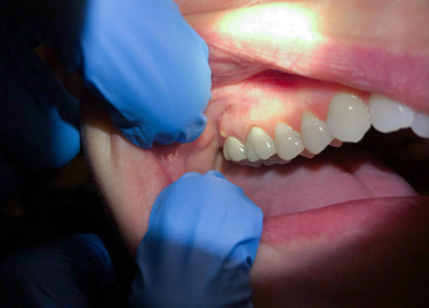 Best Emergency Gum Treatment in Cape Charles, VA