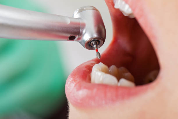 Best Emergency Tooth Extraction in Cape Charles, VA